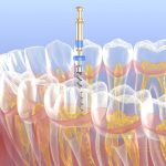 Dentist That Do Root Canals in Lakewood Ranch FL area