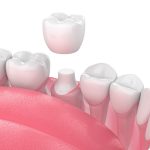 Crown Treatment for Teeth in Lakewood Ranch FL Area