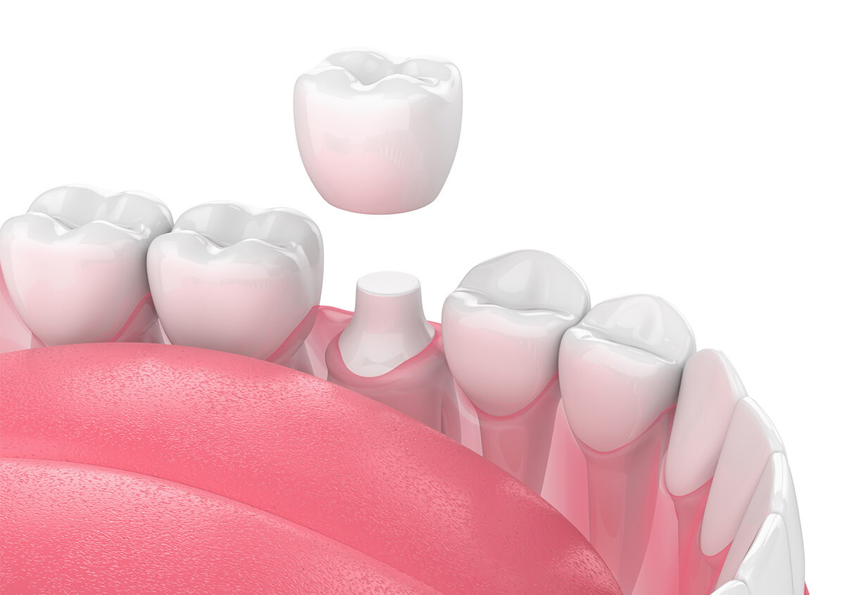 Crown Treatment for Teeth in Lakewood Ranch FL Area